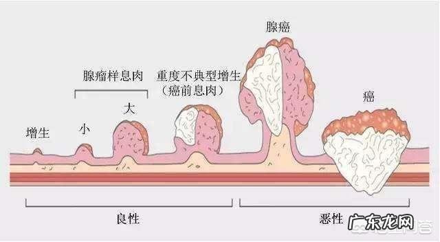 肠道息肉电切手术了,多久能恢复?