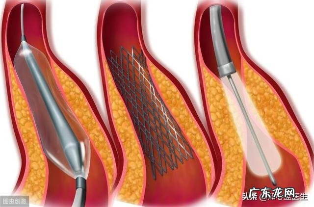 阿司匹林和氯吡格雷真的一吃就要吃一辈子吗
