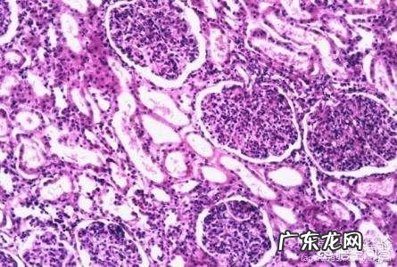 狼疮性肾炎 系统性红斑狼疮主要临床症状有哪些