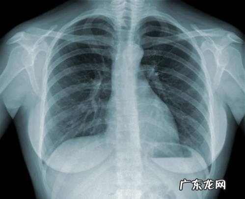 肺结节是什么?会发展成癌吗?