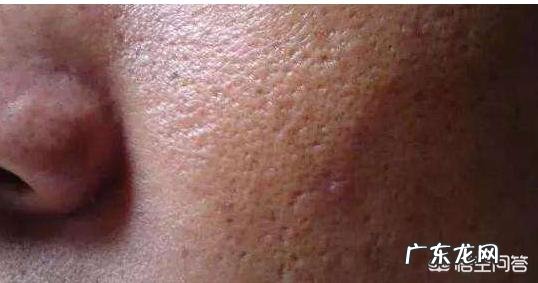 过量使用护肤品会导致毛孔粗大吗