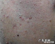 过量使用护肤品会导致毛孔粗大吗