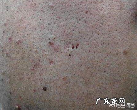 过量使用护肤品会导致毛孔粗大吗