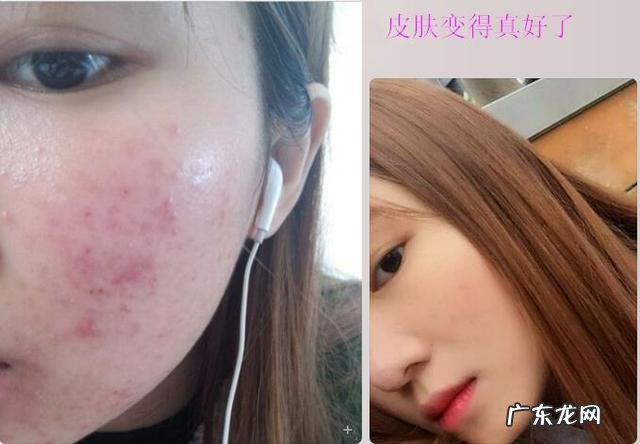 为什么毛孔粗大永远小不了还易导致肌肤过敏,有什么好的办法吗