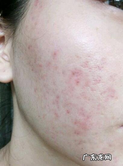 为什么毛孔粗大永远小不了还易导致肌肤过敏,有什么好的办法吗