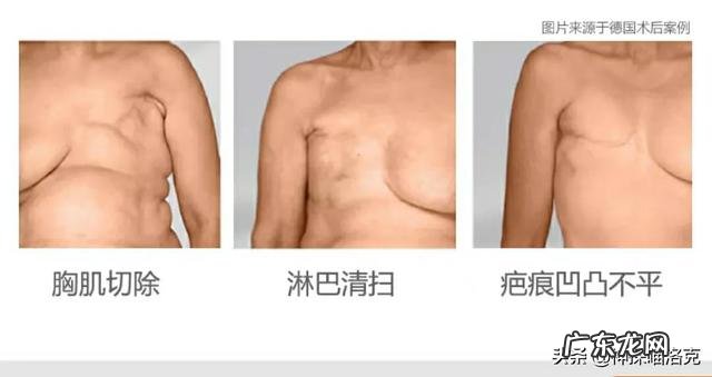 得了乳腺癌的姐妹们,你们都还好吗