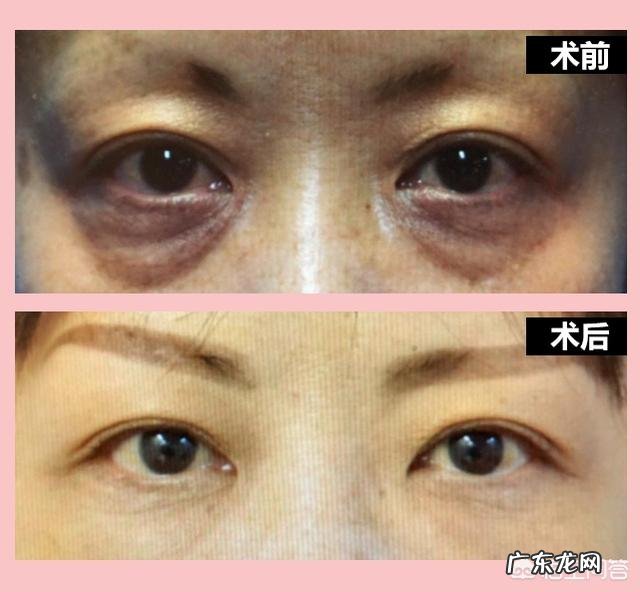 蜂蜜和纯奶小苏打怎么样去眼袋