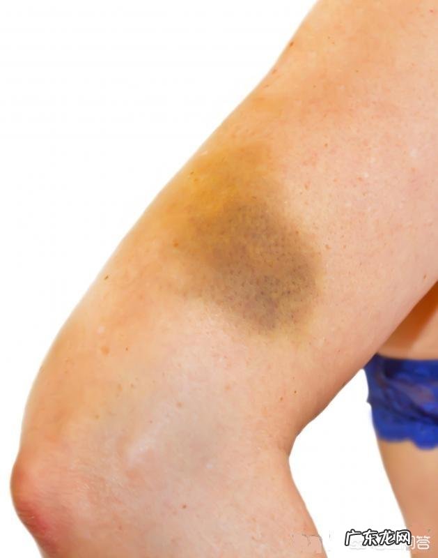 因血小板减少性紫癜,吃了二年激素药,现在骨质疏松,怎么办