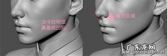 注射的玻尿酸被吸收后,皮肤会松弛吗