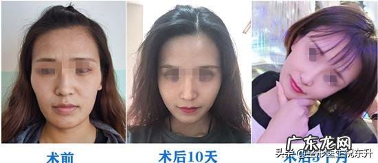 注射的玻尿酸被吸收后,皮肤会松弛吗