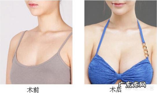 进行假体隆胸后，应该注意什么