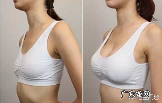 进行假体隆胸后，应该注意什么