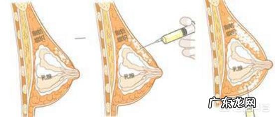 进行假体隆胸后，应该注意什么