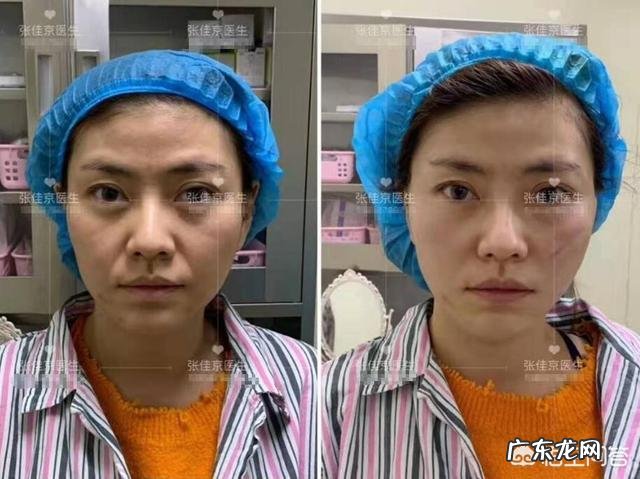 线雕后苹果肌大了,能恢复吗