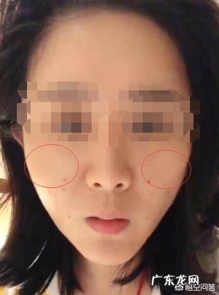 线雕后苹果肌大了,能恢复吗