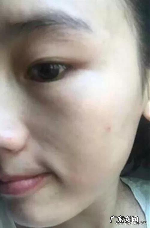 吃黄体酮后斑会立马长出来吗