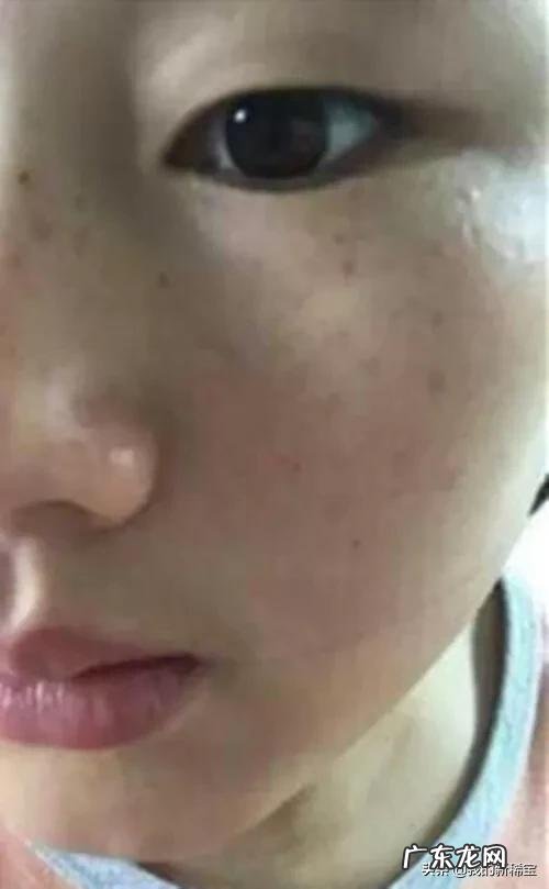 吃黄体酮后斑会立马长出来吗