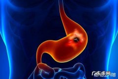 胃溃疡是种什么病哪些因素会引起胃溃疡呢