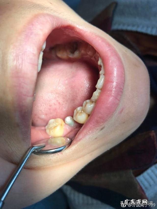 种植牙有异物感的原因是什么