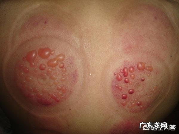 大暑前后出现6个症状,说明湿毒入侵身体,到底是哪6个症状