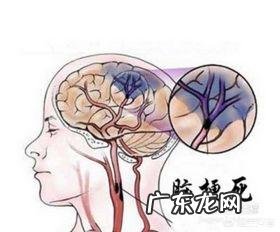脑血管病人病情稳定后能不能自行停药