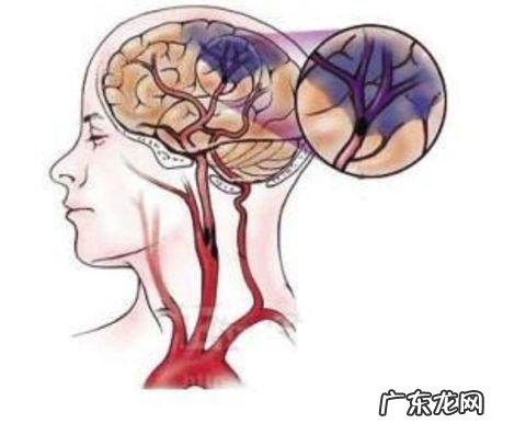 脑血管病人病情稳定后能不能自行停药