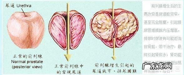 前列腺增生,饮食应该注意哪些