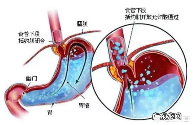 得了反流性食道炎是一种什么样的体验