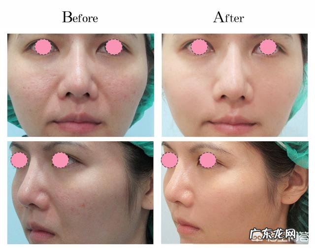 养生美容养颜方面,法令纹怎么去掉