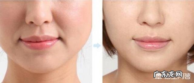 养生美容养颜方面,法令纹怎么去掉