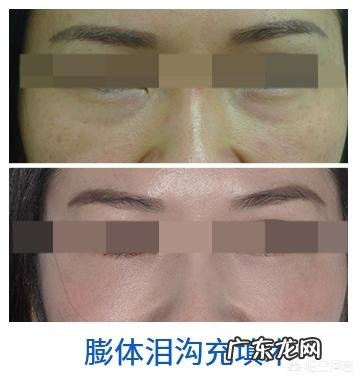 什么方法或者美容品去眼袋效果好