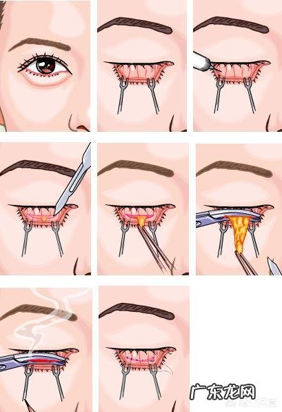 什么方法或者美容品去眼袋效果好