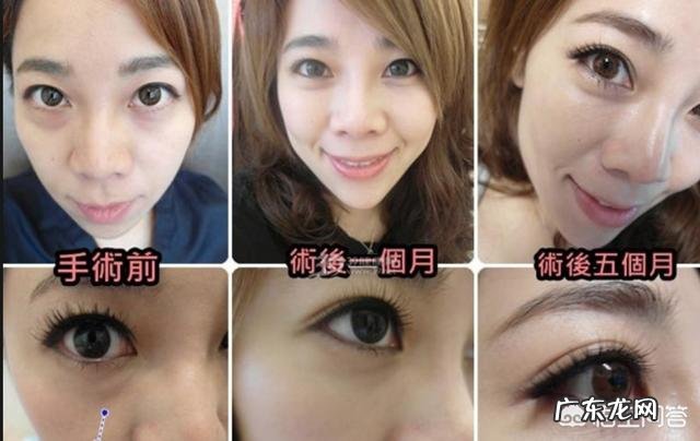 什么方法或者美容品去眼袋效果好