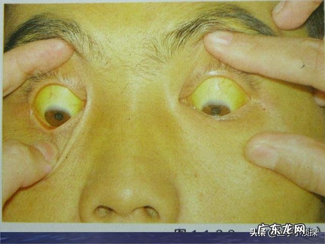 胃部出现癌变会有哪些征兆