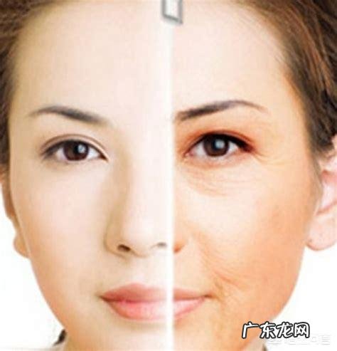 如何改善脸部的下垂和法令纹