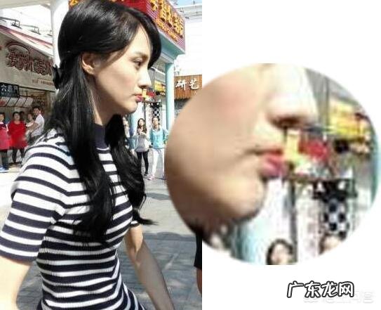 如何改善脸部的下垂和法令纹