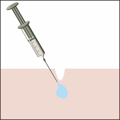 如何改善脸部的下垂和法令纹
