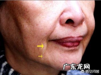 如何改善脸部的下垂和法令纹