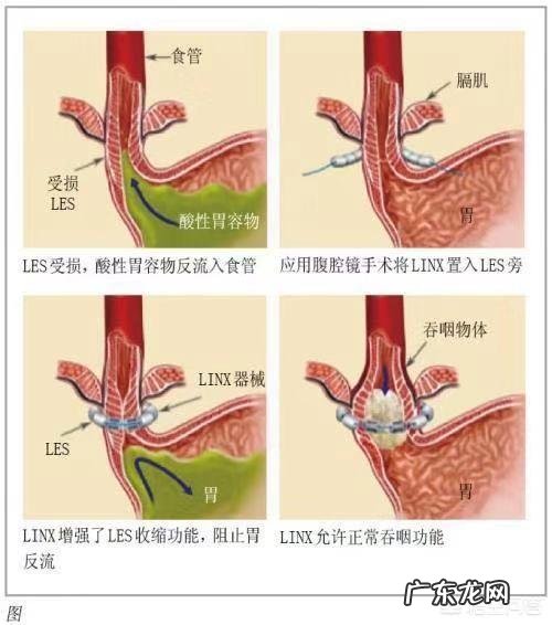 胃食管反流能引起食道癌么