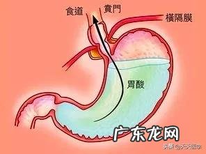 胃食管反流能引起食道癌么