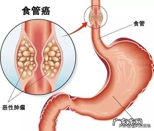 胃食管反流能引起食道癌么