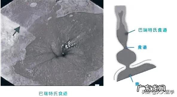 胃食管反流能引起食道癌么