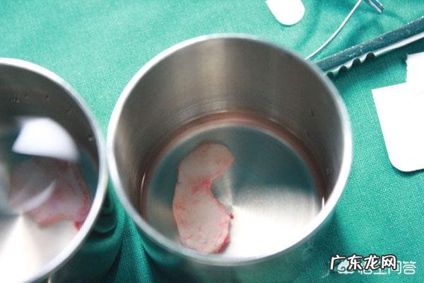 肋骨隆鼻后,肋骨会被吸收吗原因是什么需要注意哪些问题