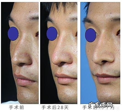 肋骨隆鼻后,肋骨会被吸收吗原因是什么需要注意哪些问题