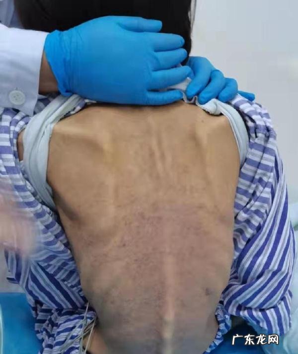 减肥过度厌食症 130斤的女生减肥失败后患有暴食症