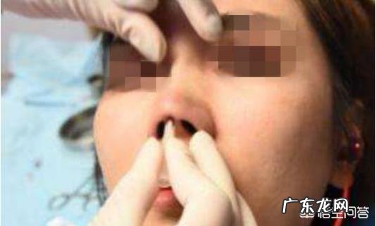 线雕鼻子疼吗线雕提升一般能维持多久