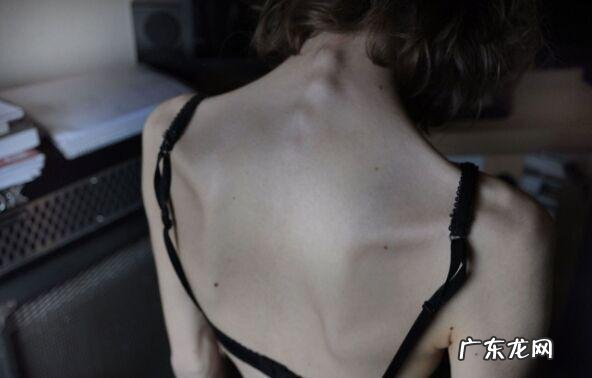 厌食症女生减肥上瘾 厌食症增重