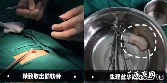 肋软骨隆鼻有哪些并发症,会被吸收吗,会不会弯曲变形