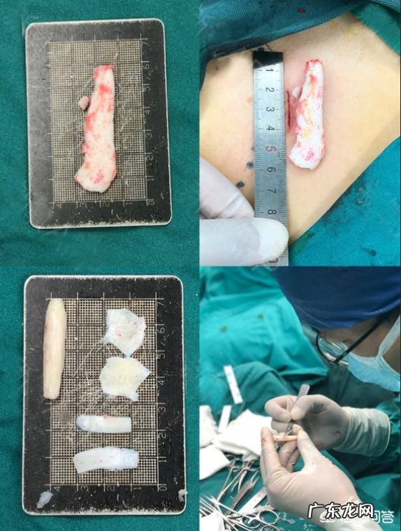 肋软骨隆鼻有哪些并发症,会被吸收吗,会不会弯曲变形