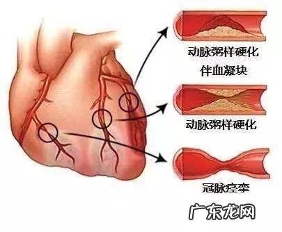做完心血管造影以后,可不可以经常吃药